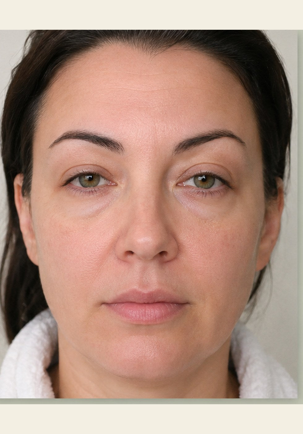 Front view, eye area and midface, before