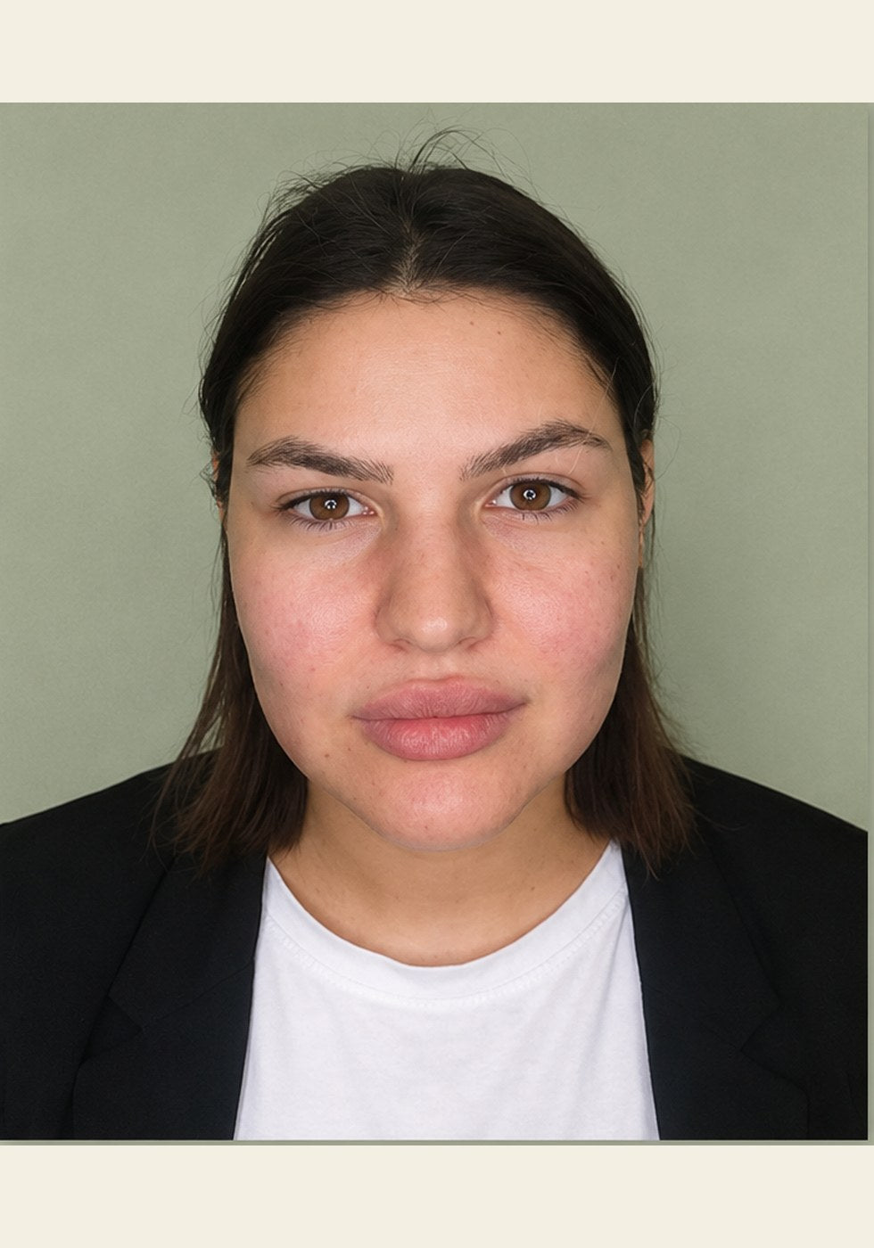 Front view, cheeks and jawline, before