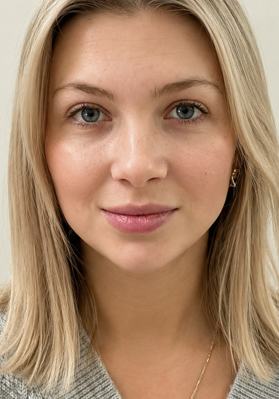 Front view, under-eye puffiness, after