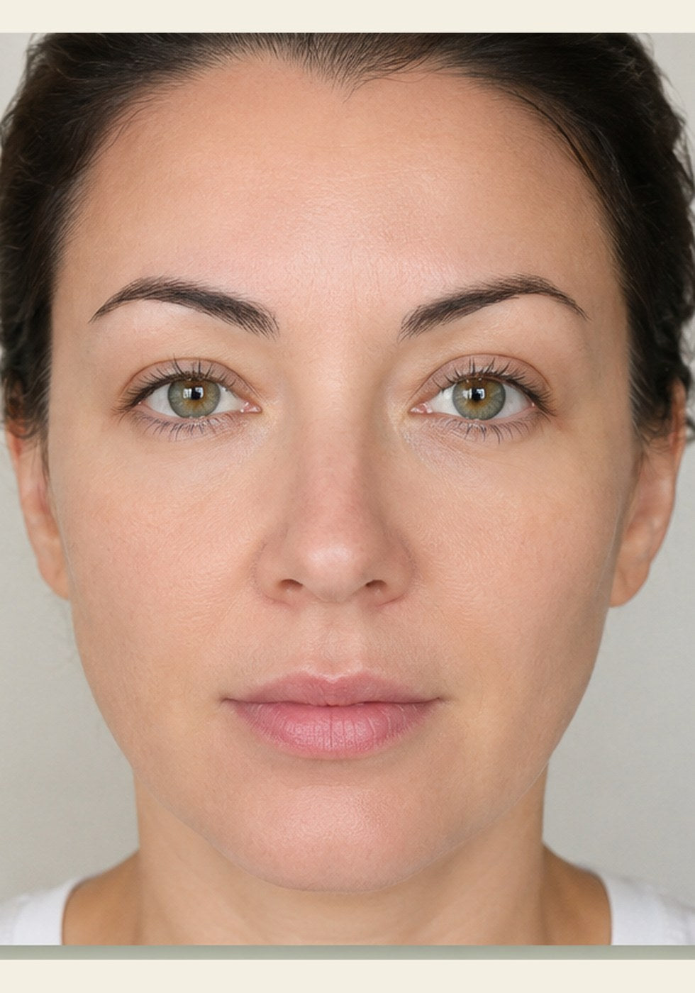Front view, eye area and midface, after