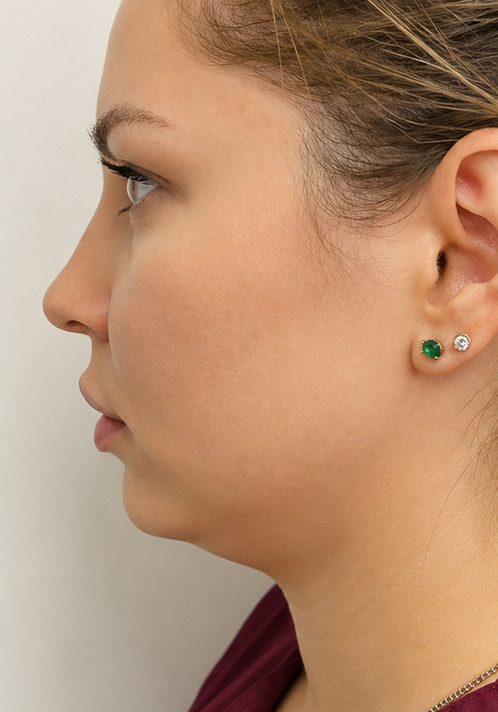 Profile, jawline and neck, before