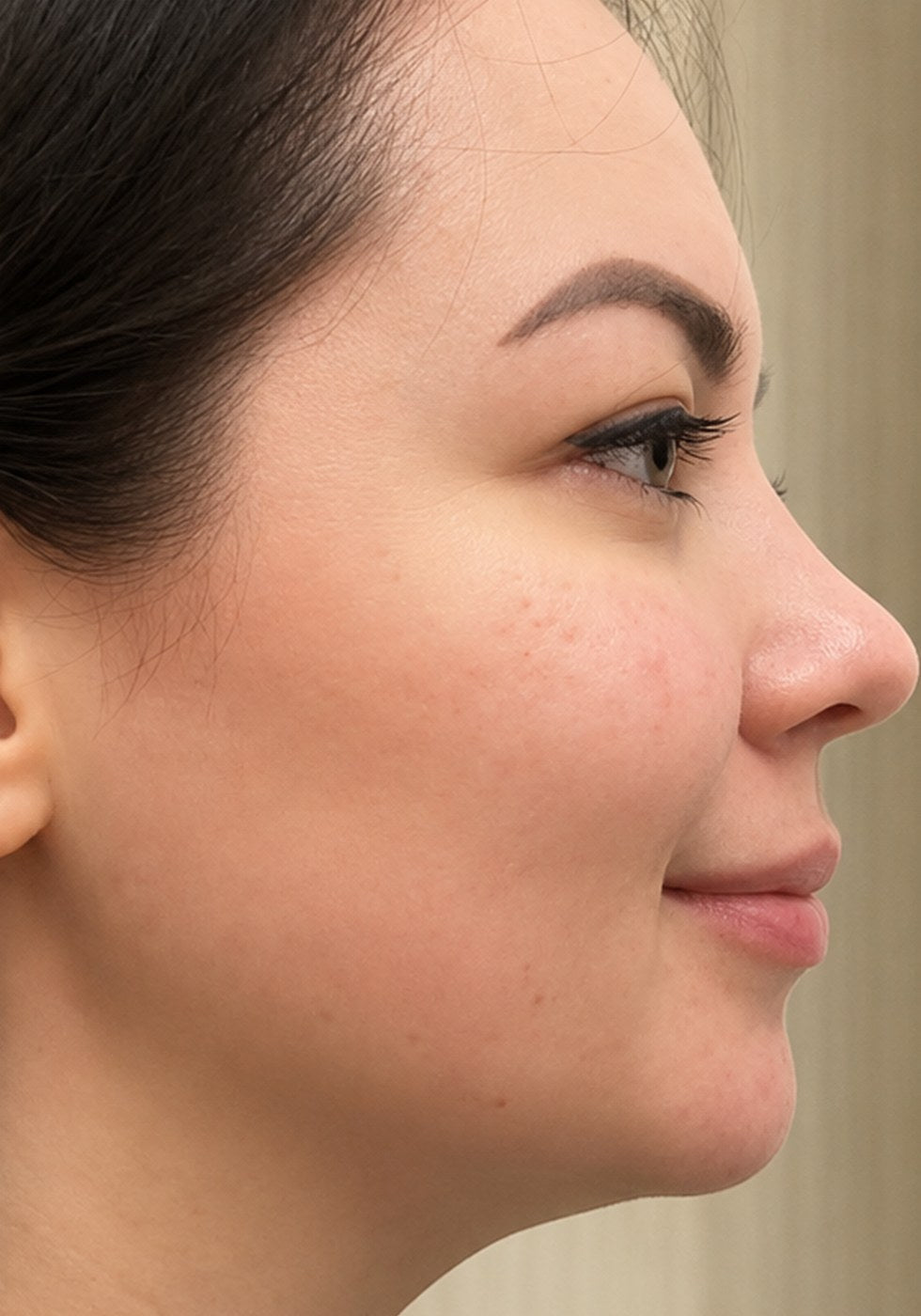 Profile, cheek and chin line, after