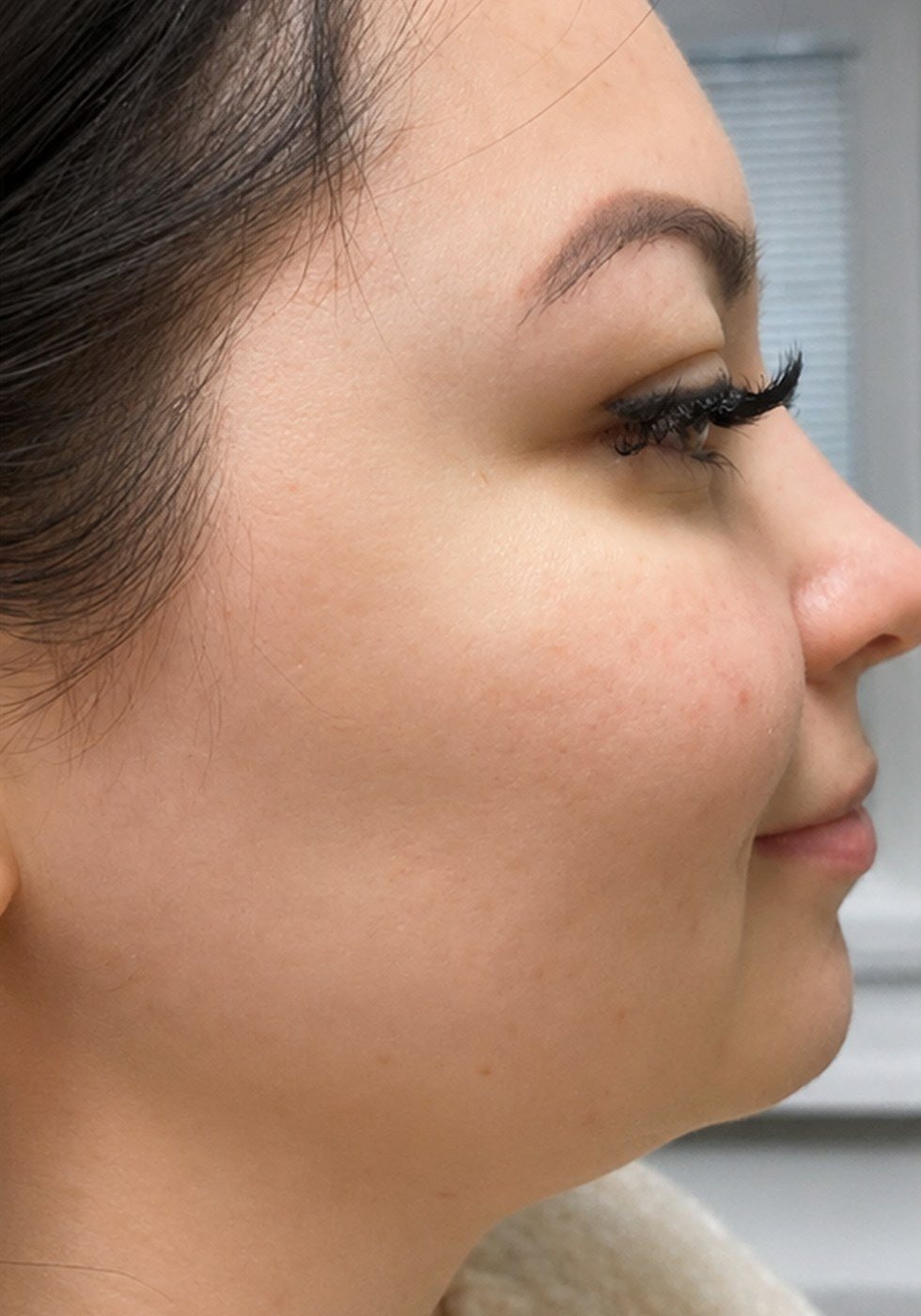 Profile, cheek and chin line, before
